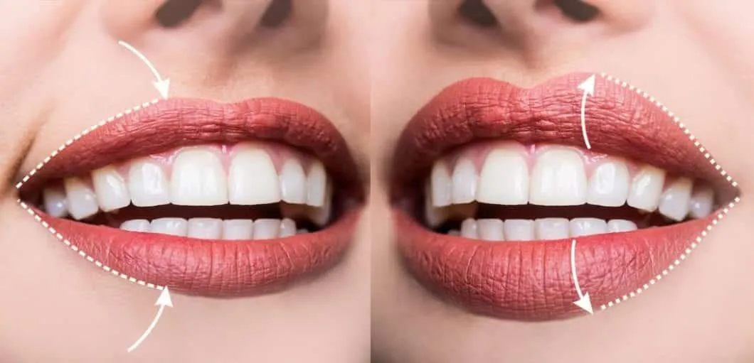 What's your lip filler, how much is a contra-indication