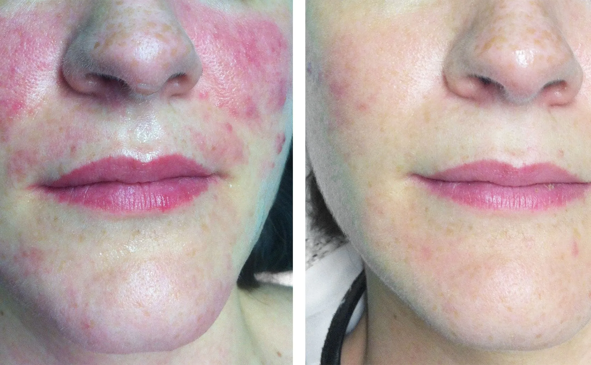 Rosacea – What it is, symptoms, causes and treatment