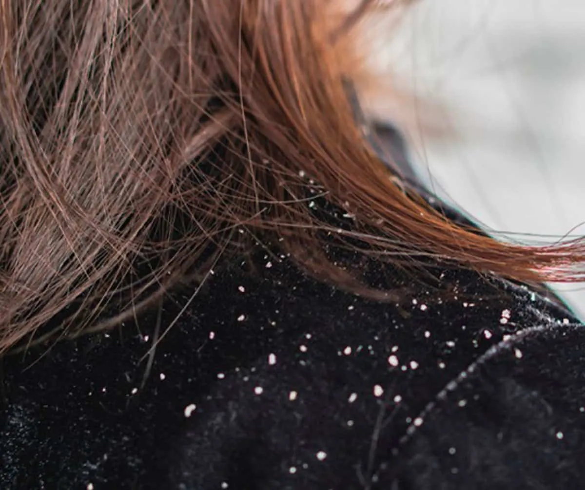 How to get rid of dandruff?  best tips with homemade recipes