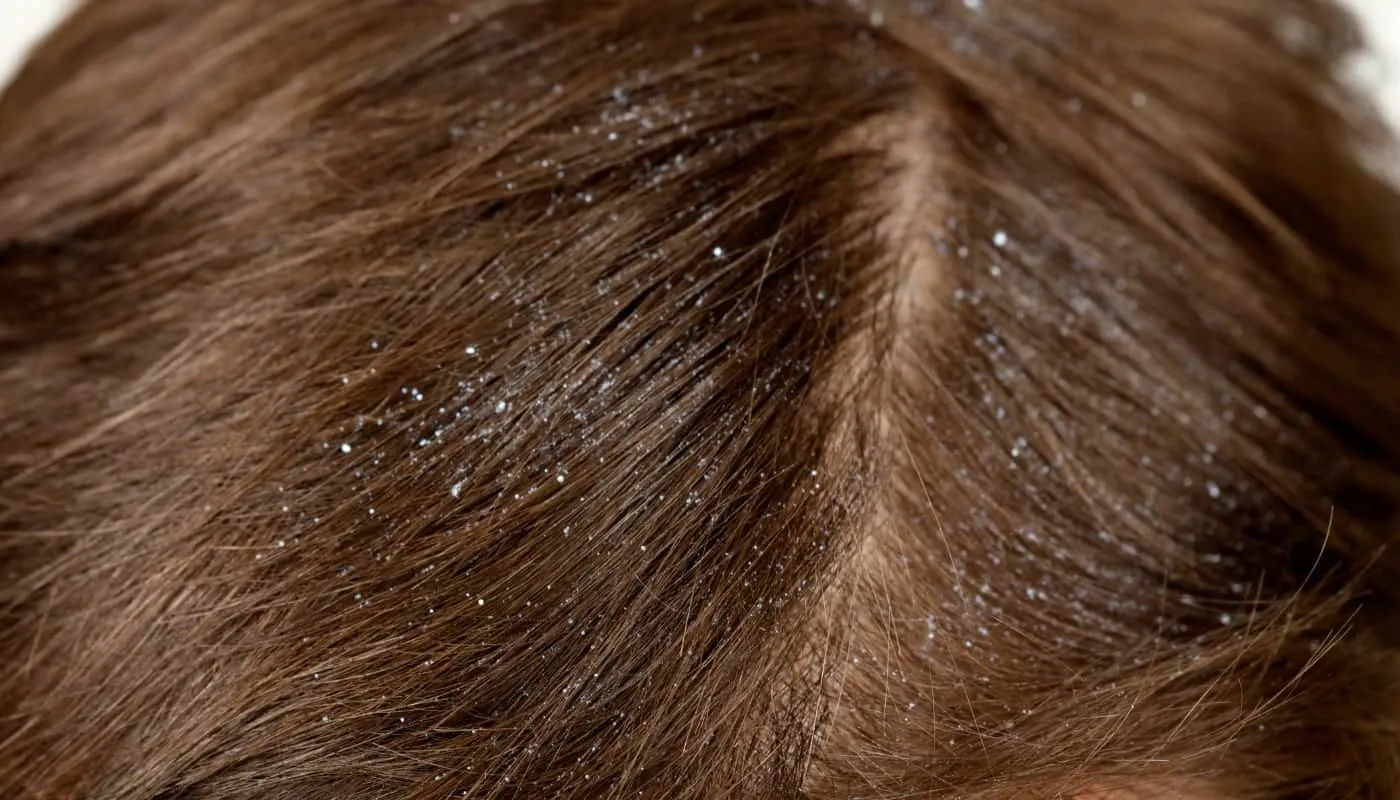 How to get rid of dandruff?  best tips with homemade recipes