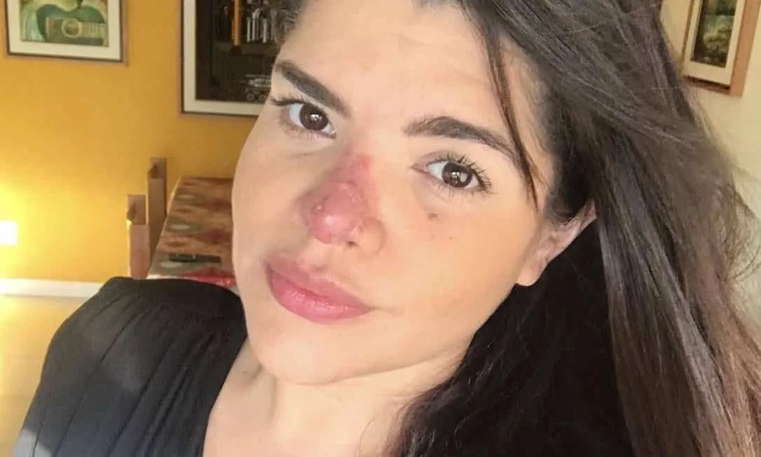 Hyaluronic acid, what is it? Find out what it’s for and how to use it